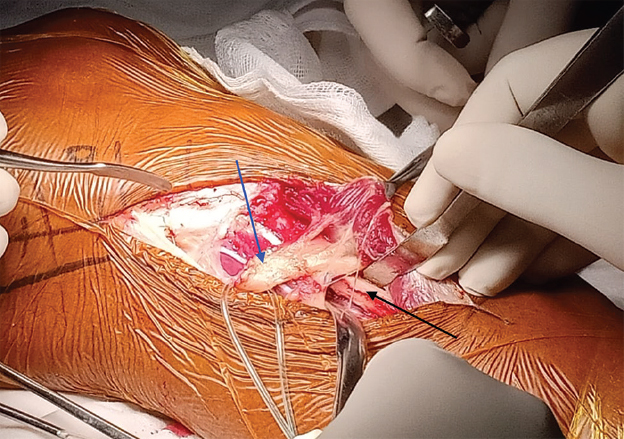 Intra-operative photograph demonstrating the common peroneal nerve (blue arrow) dissected free off the right proximal fibula (black arrow).